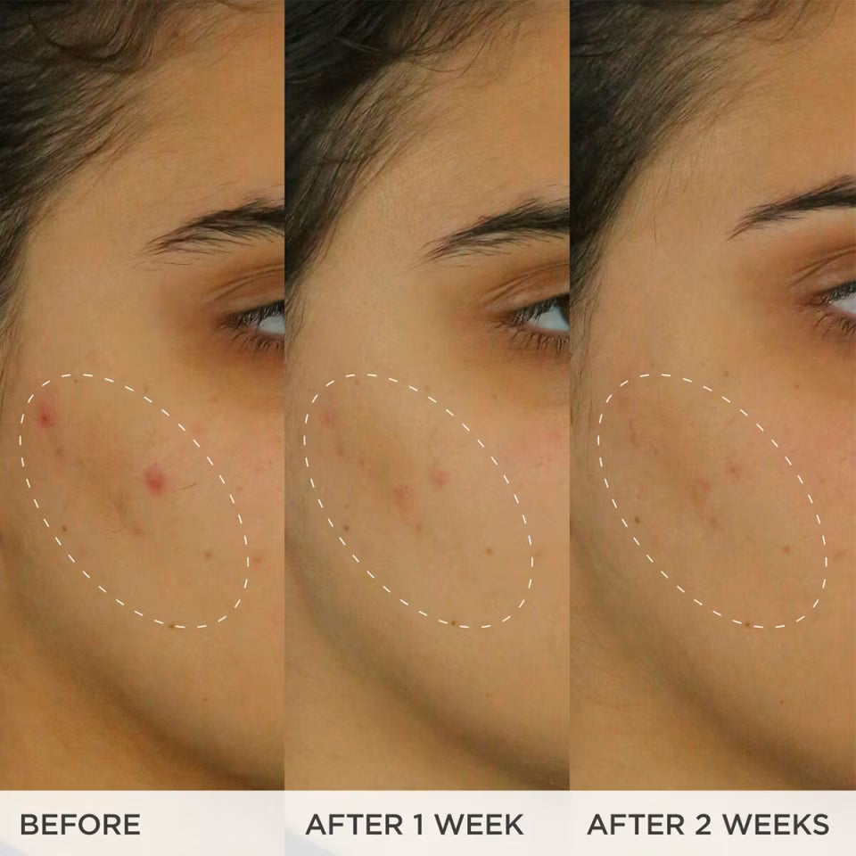 The Brightening Serum | Vitamin C Treatment for Brighter, Firmer Skin – Targets Hyperpigmentation & Fades Post-Acne Marks, 30 ml / 1.0 fl. oz.